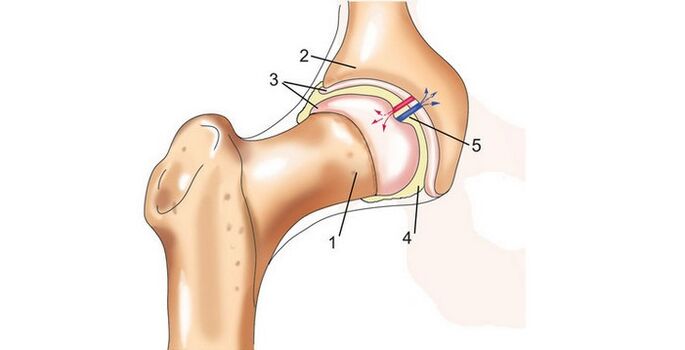 articulația șoldului și artroza