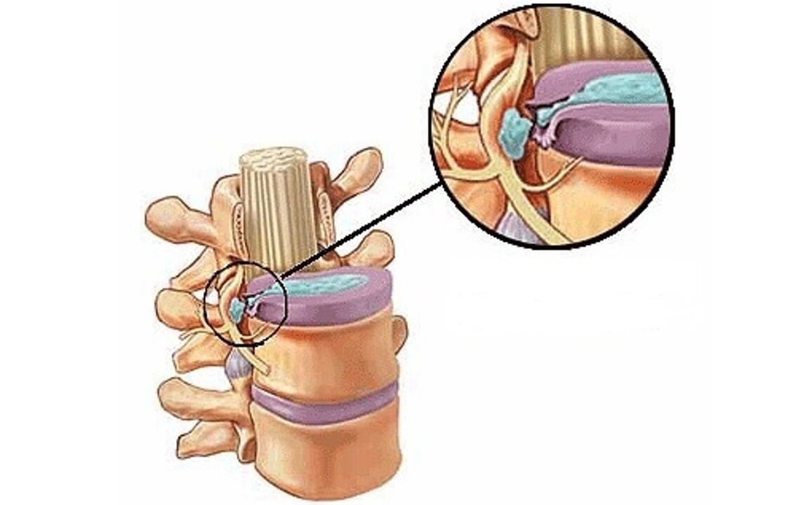 hernie intervertebrală cu osteocondroză toracică